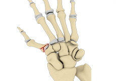 Bennett's Fracture