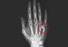 Boxer's Fracture