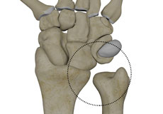 Distal Radioulnar Joint (DRUJ) Arthritis