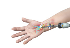 Endoscopic Carpal Tunnel Surgery