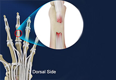 Extensor Tendon Injuries