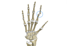 Finger Dislocation