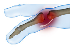 Finger Joint Dislocation and Volar Plate Injury