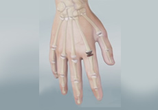 Finger Joint Implant