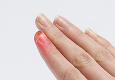 Fingertip Injuries