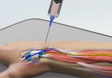 Ganglion Cyst Removal