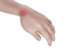 Hand Infections