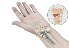 Distal Radius Osteotomy to Correct Mal-Union (Crooked Painful Wrist)
