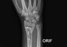 ORIF of Distal Radius Fracture