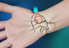 Scaphoid Fracture