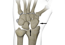 Scapholunate Advanced Collapse (SLAC): Wrist Osteoarthritis