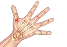 Arthritis of the Thumb