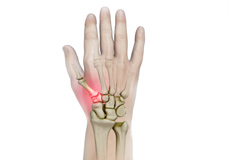 Trapeziometacarpal (TMC) Arthritis