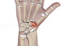 Triscaphoid Joint Arthritis