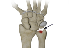 Ulnar Carpal Impaction