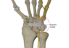 Ulnar Nerve Compression in Guyon's Canal