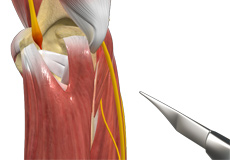 Ulnar Nerve Transposition