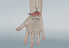 Arthritis of the Hand and Wrist