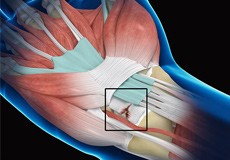 Wrist Ligament Tear and Instability