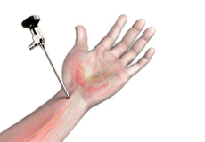 Wrist Arthroscopy